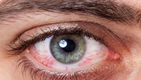 أعراض في العينين تدل على مشكلات خطيرة في الجسم