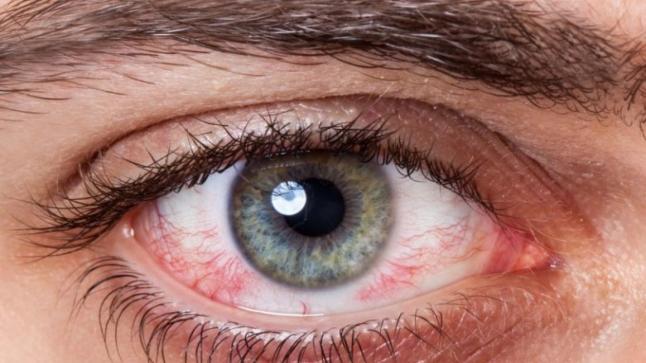 أعراض في العينين تدل على مشكلات خطيرة في الجسم