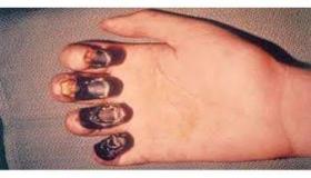 الصحة العالمية تطمئن العالم من مرض الطاعون الدبلي