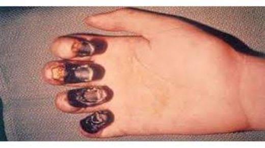 الصحة العالمية تطمئن العالم من مرض الطاعون الدبلي